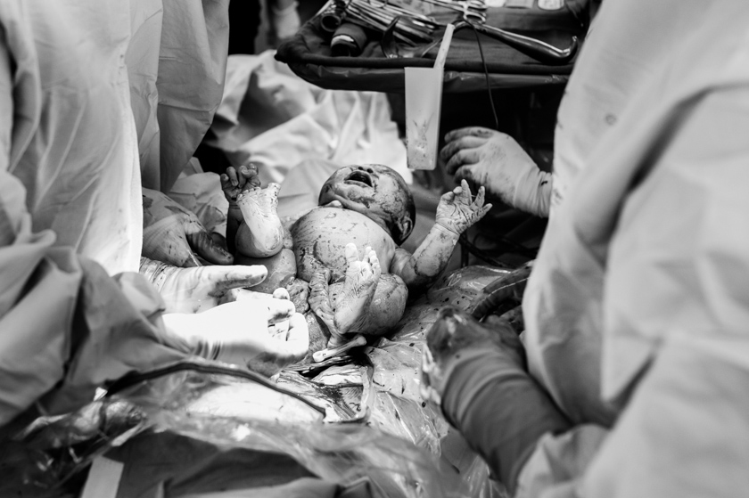 baby right after c-section delivery